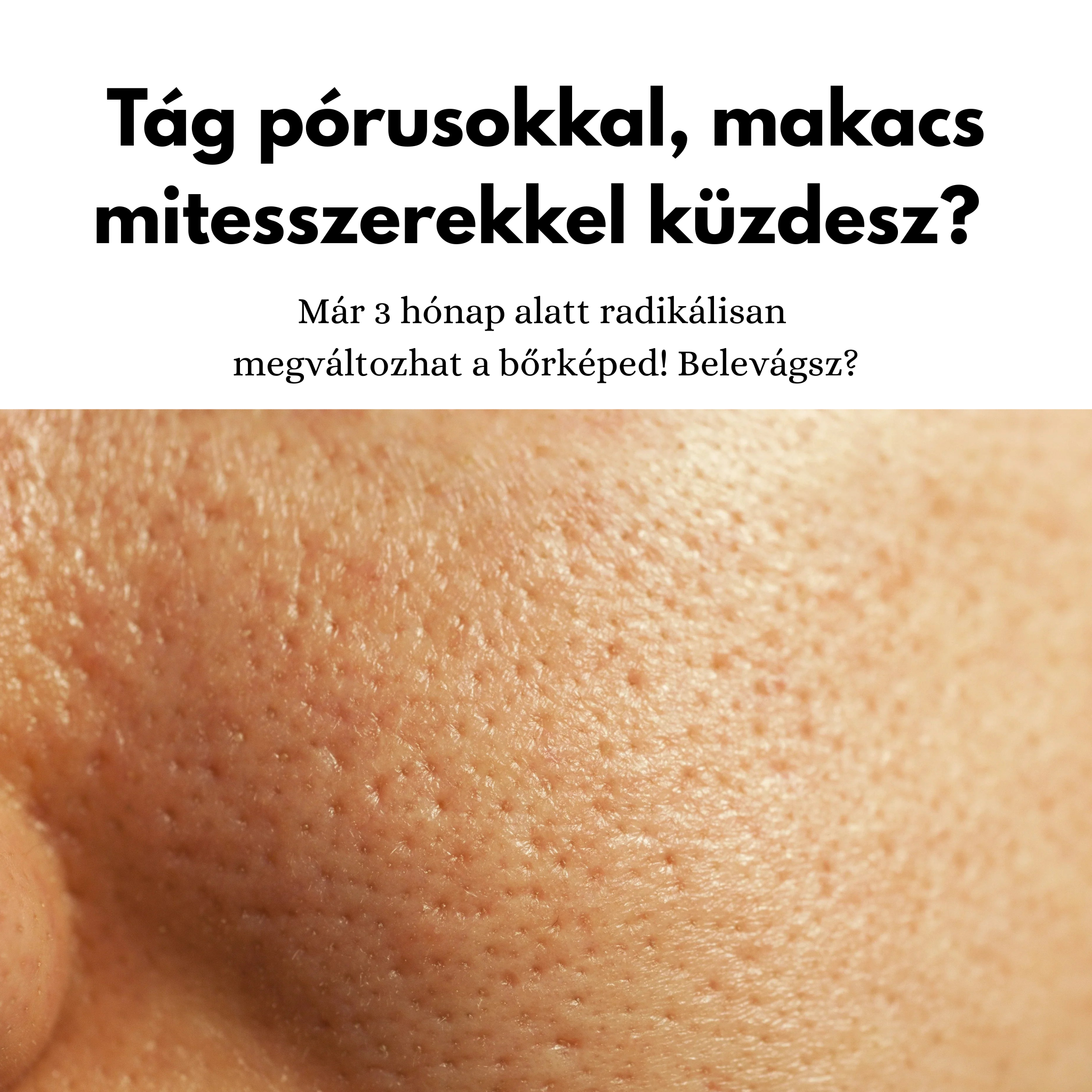 Tág pórusok, mitesszerek EBOOK