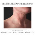Ekcéma Signature 6 Hónapos Program